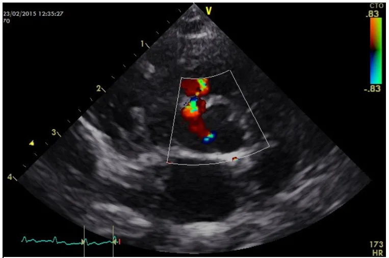 Colour doppler image courtesy of Emily Dutton at Cheshire Cardiology