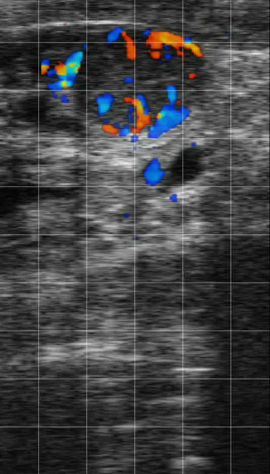 Corpus luteum CFM on ESG 2